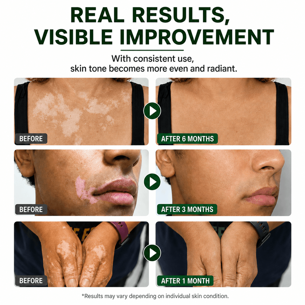 Vitiligo Repigmentation Balm by LuminaDerm