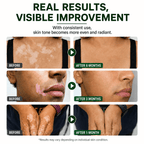 Vitiligo Repigmentation Balm by LuminaDerm