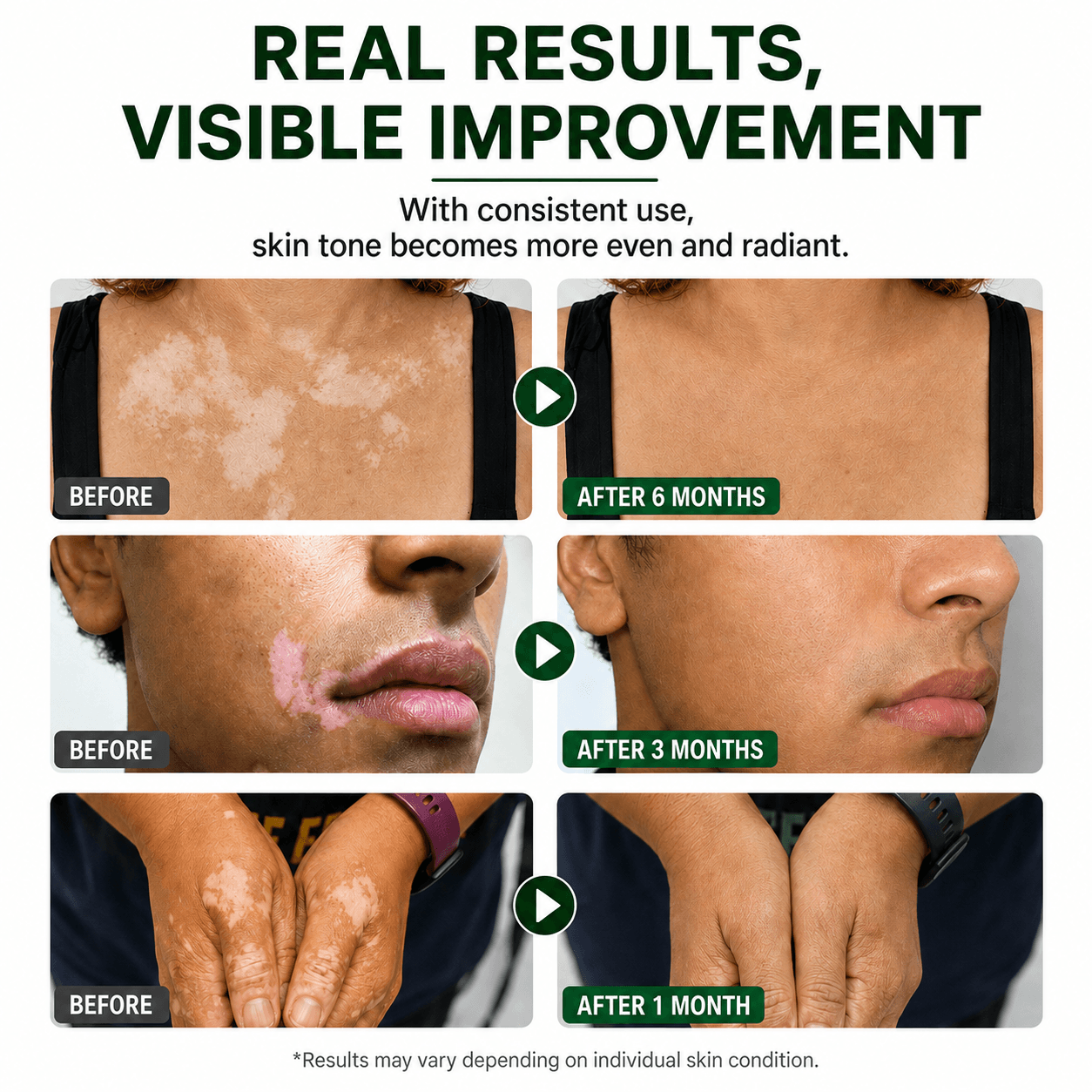 Vitiligo Repigmentation Balm by LuminaDerm